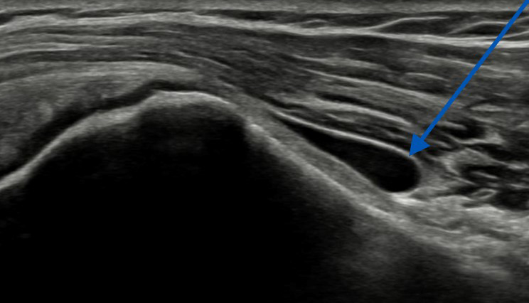 pijnmc-subacromiale bursitis-echo